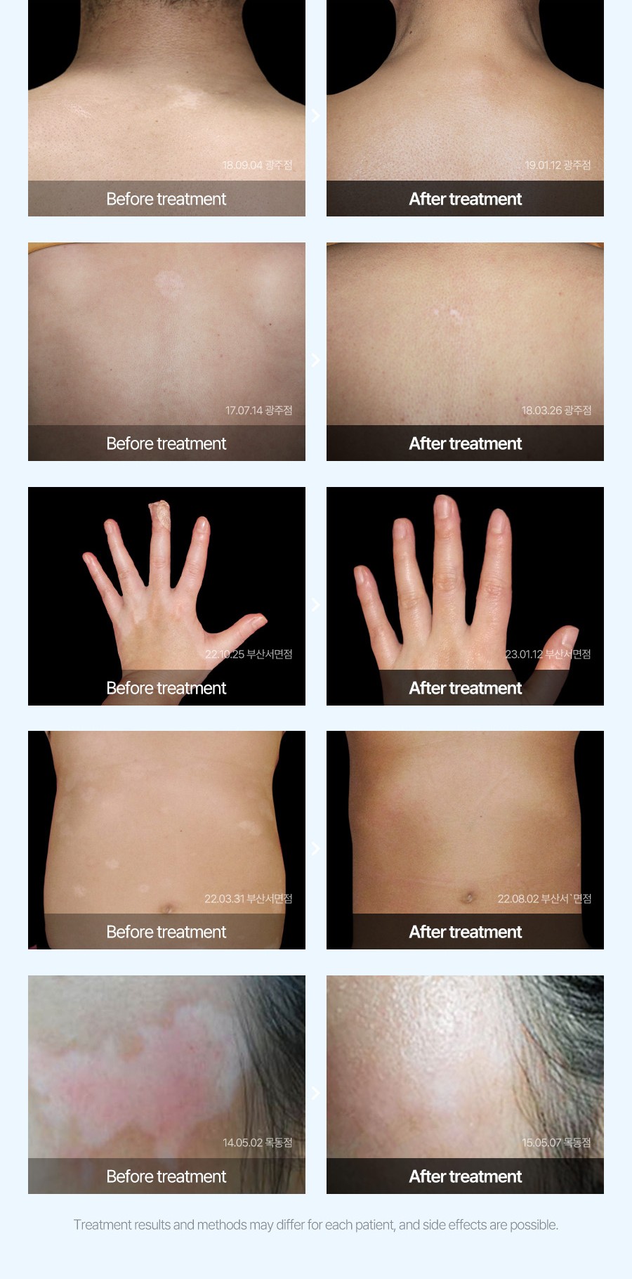 백반증 치료 전후 사례