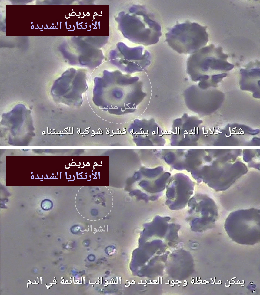 دم مريض يعاني من أرتكاريا شديدة