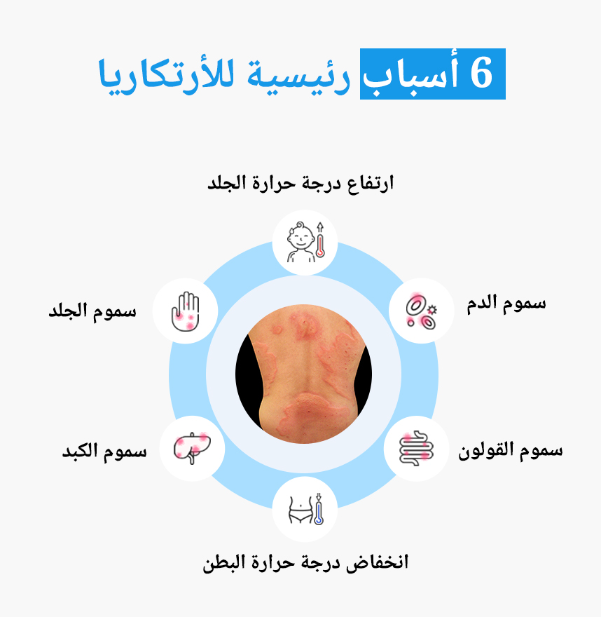 الأسباب الستة الرئيسية للأرتكاريا