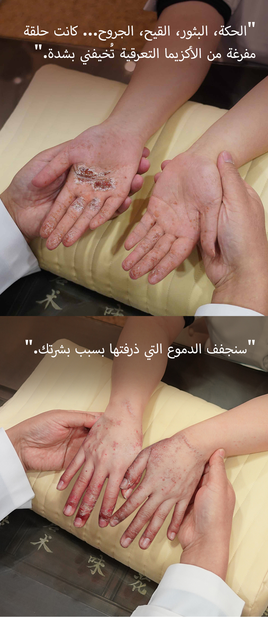 كان من المرعب أن أكون محاصرًا في حلقة مفرغة من الحكة، البثور، السوائل، والجروح بسبب الإكزيما الديسكويدية.