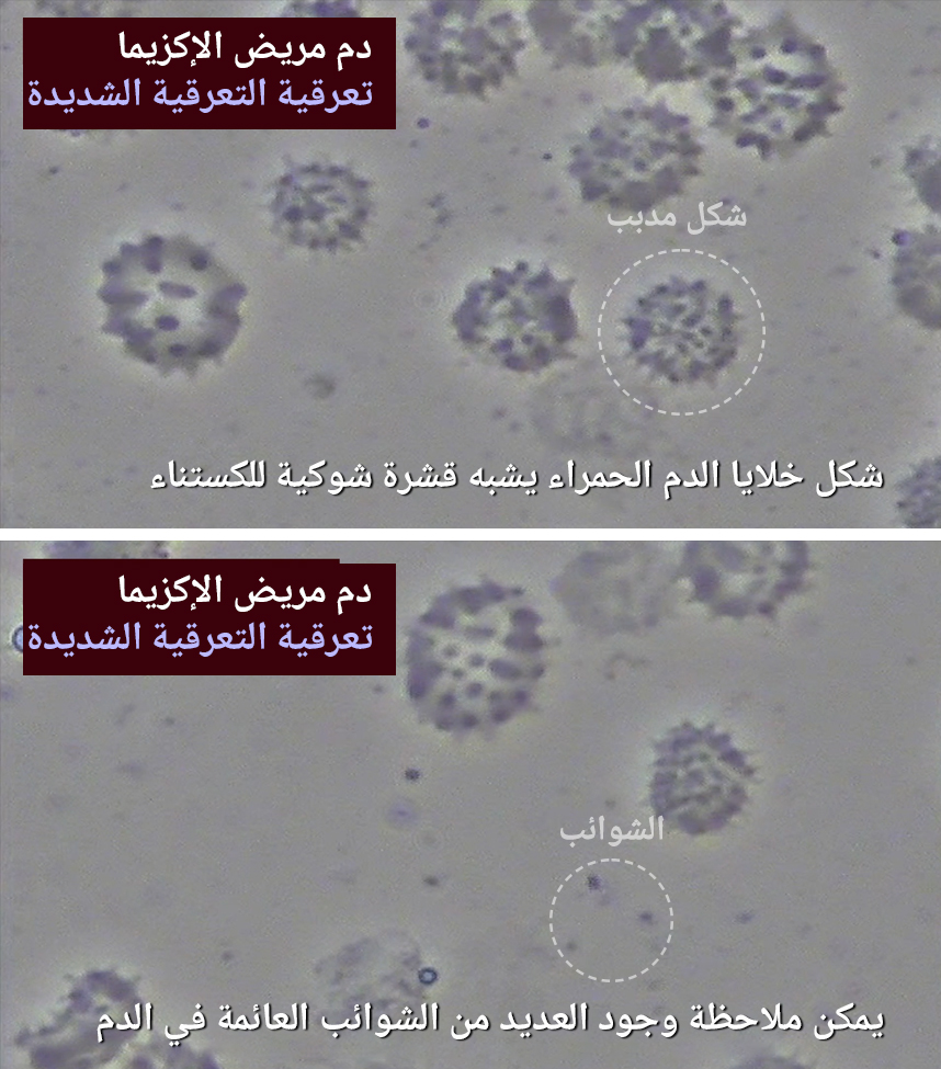 دم مريض يعاني من إكزيما نقطية شديدة
