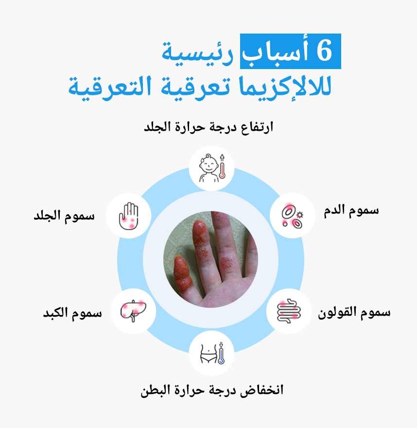 الأسباب الستة الرئيسية للإكزيما نقطية