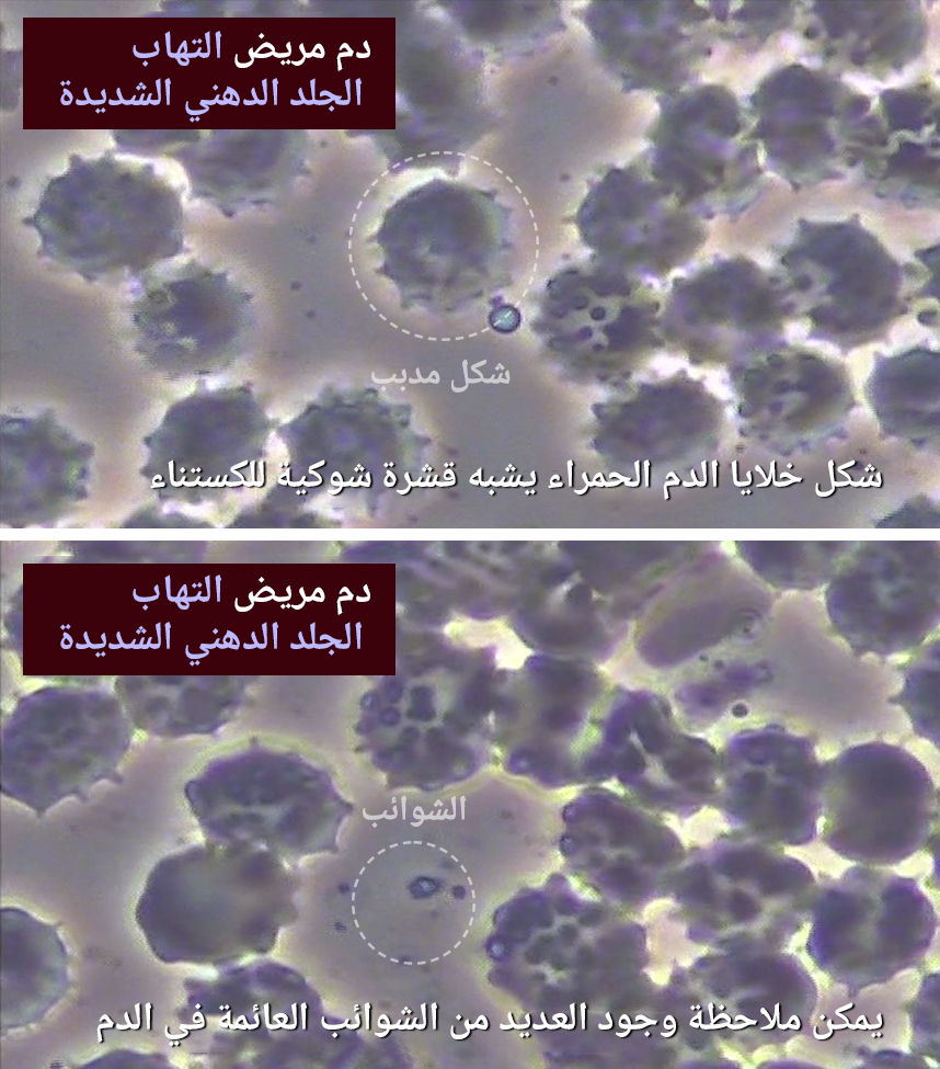 دم مريض يعاني من التهاب الجلد الدهني شديدة