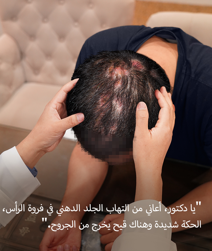 دكتور، التهاب الجلد الدهني في فروة رأسي يسبب لي حكة شديدة، وهو يخرج سائلًا.