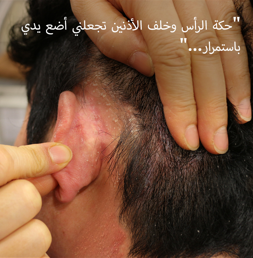 رأسي ومن خلف أذني يسببان لي الحكة، وأنا أستمر في الخدش...