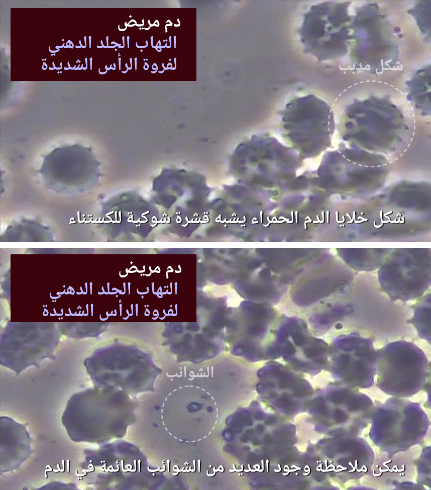دم مريض يعاني من التهاب الجلد الدهني لفروة الرأس لفروة الرأس شديدة