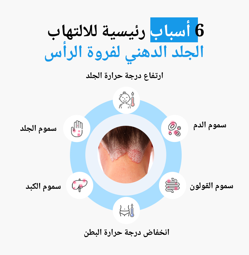 الأسباب الستة الرئيسية للالتهاب الجلد الدهني لفروة الرأس لفروة الرأس