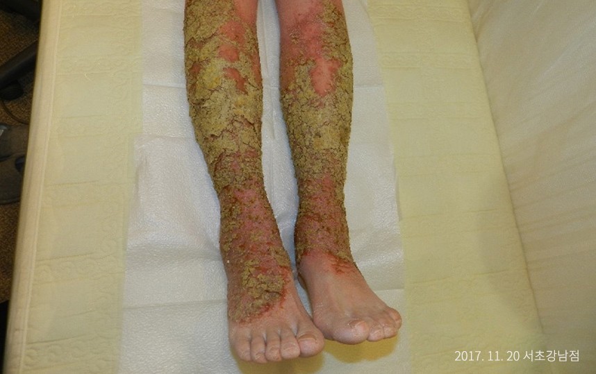 습진 병력