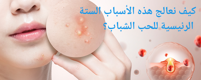 كيف نعالج هذه الأسباب الستة الرئيسية للحب الشباب؟