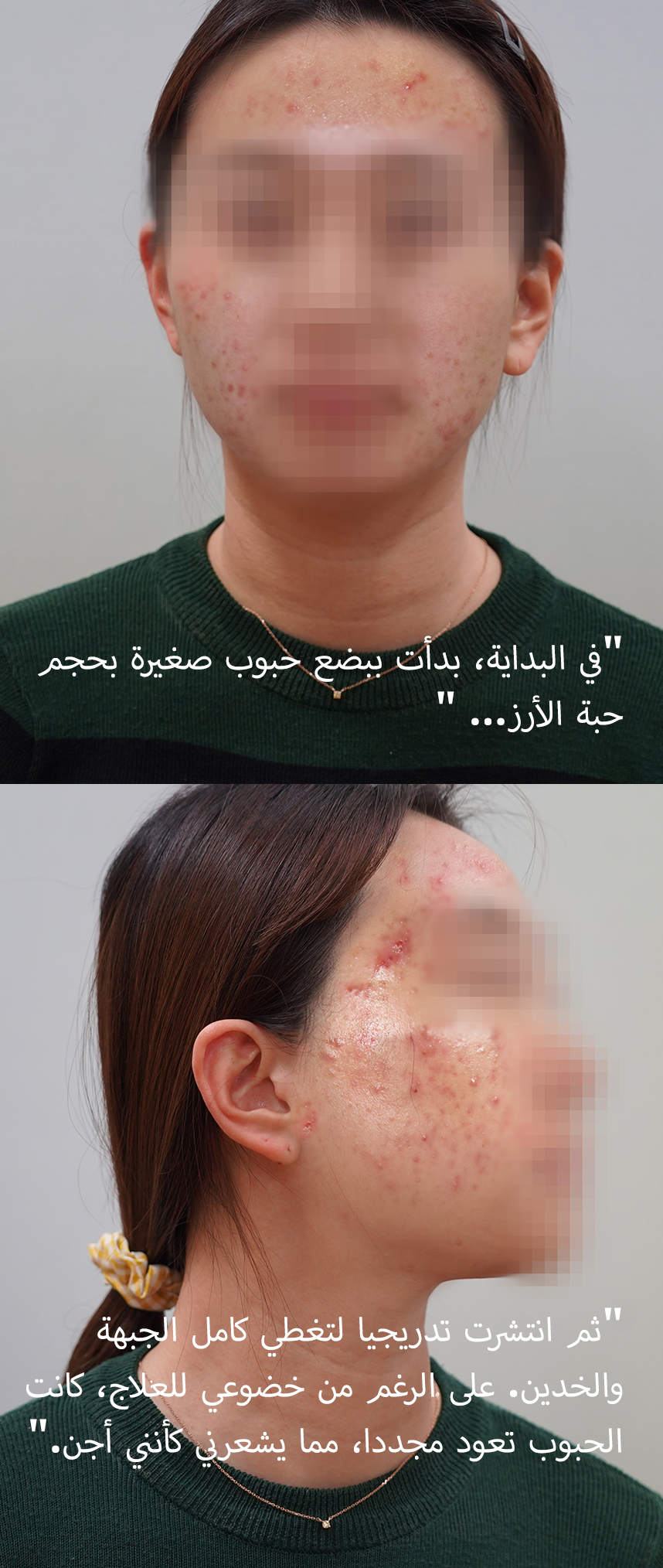 في البداية، بدأت تظهر لي بعض الحبوب الصغيرة، لكن...