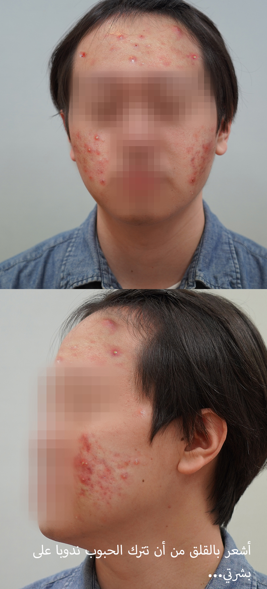 أنا قلق من أن تترك الندوب...