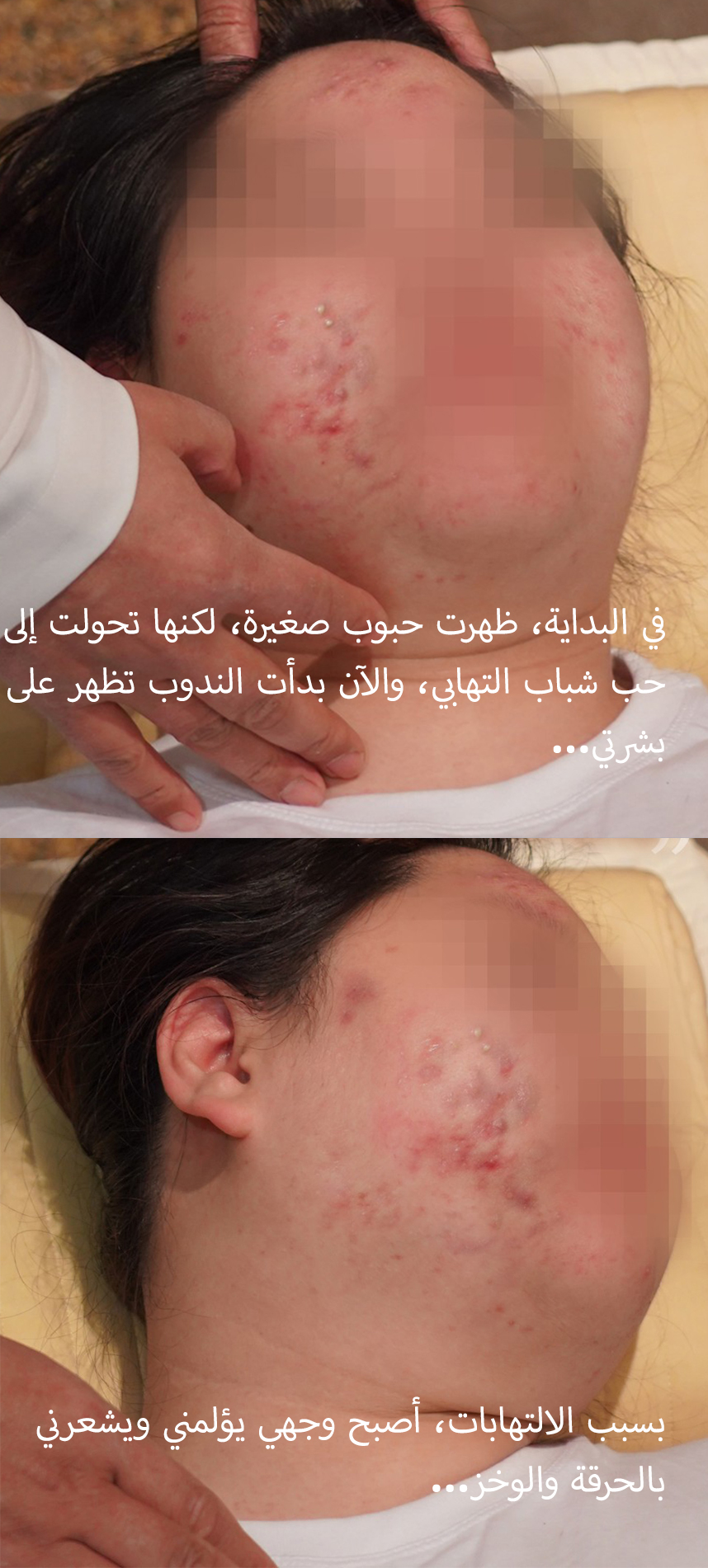 في البداية، كان لدي حبوب صغيرة، ثم تحولت إلى حب الشباب الالتهابي، والآن توجد ندوب أيضًا...