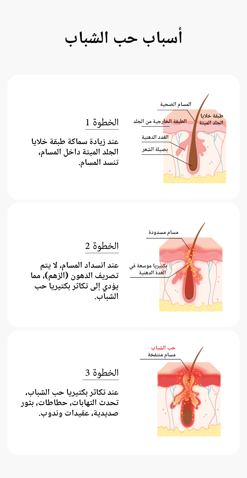 أسباب حب الشباب - الخطوة 1  عندما تتسمك الكيراتين في المسام، فإن المسام تسد. ,الخطوة 2  عندما تسد المسام، لا يمكن إفراز الزهم، مما يؤدي إلى تكاثر بكتيريا حب الشباب. ,الخطوة 3  عندما تتكاثر بكتيريا حب الشباب، تحدث الالتهابات، والآفات، والبثور، والعقيدات، والندوب. 
