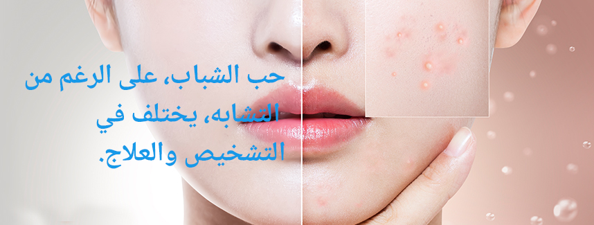 حب الشباب قد يبدو مشابهًا، لكنه يحمل تشخيصات وعلاجات مختلفة!