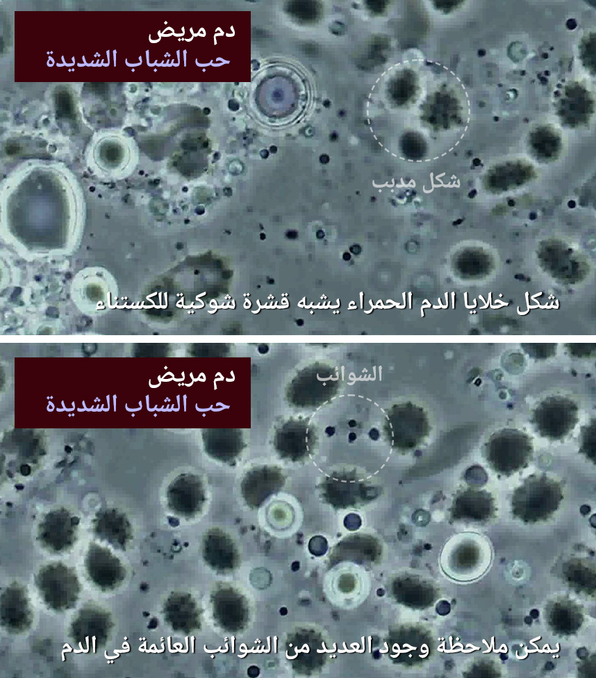 دم مريض يعاني من حب الشباب شديدة