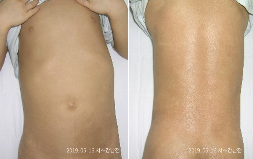 하늘마음한의원 청열 해독후 치료된 모습