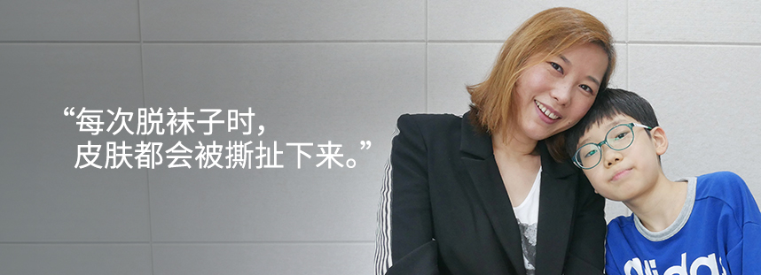 Every time I took off my socks, my skin would peel off.