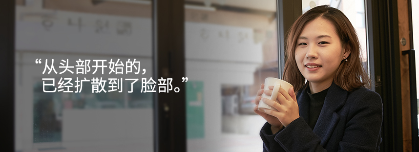 It started from my head and spread down to my face.e