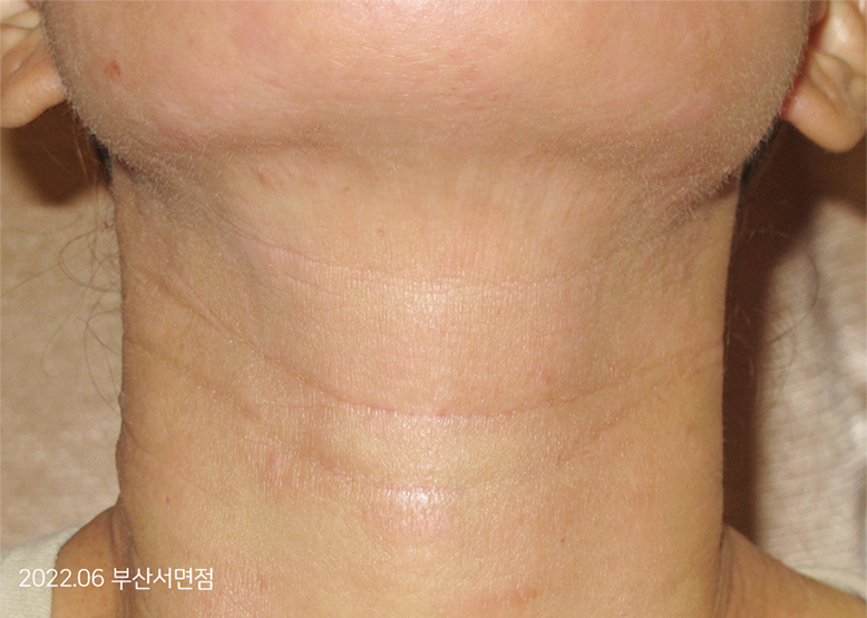 After Treatment of Urticaria