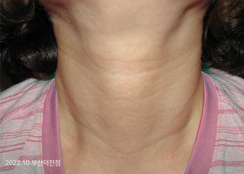 After Treatment of Urticaria