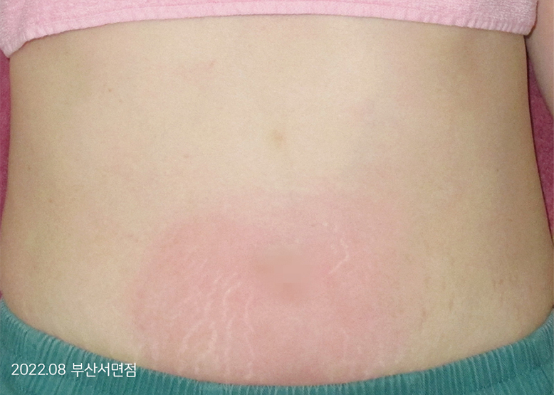 Before Treatment of Urticaria