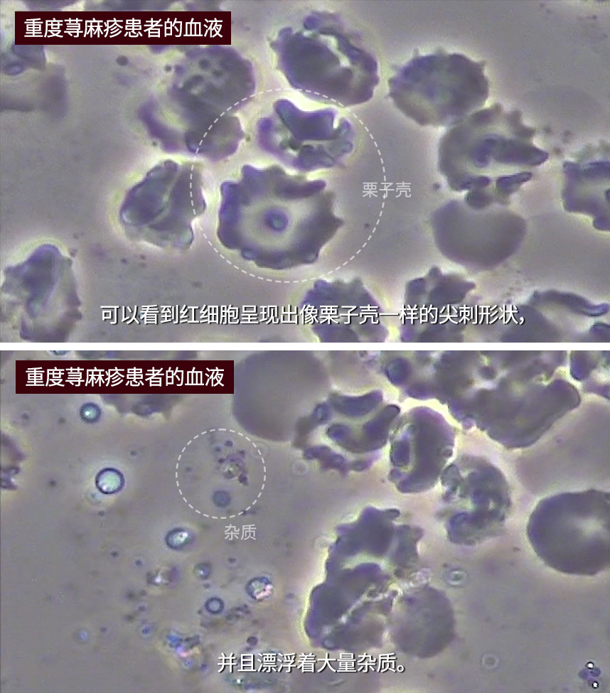 Blood of a patient with severe urticaria 