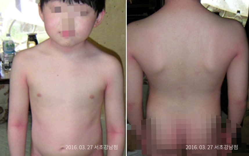 하늘마음한의원 청열 해독후 건선이 치료된 모습