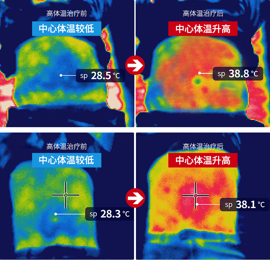 High-Frequency Thermal Therapy