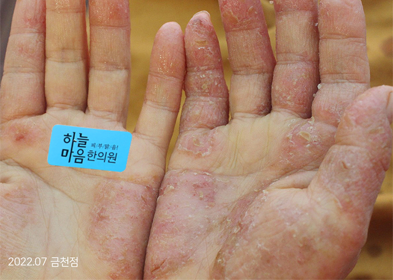 Before Treatment of Dyshidrotic eczema