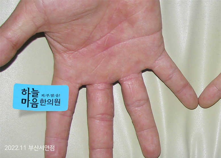 After Treatment of Dyshidrotic eczema