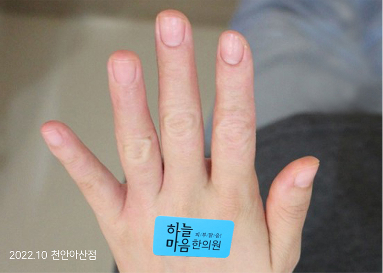 After Treatment of Dyshidrotic eczema