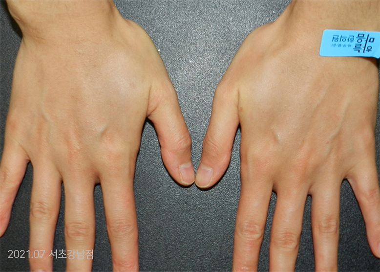 After Treatment of Dyshidrotic eczema