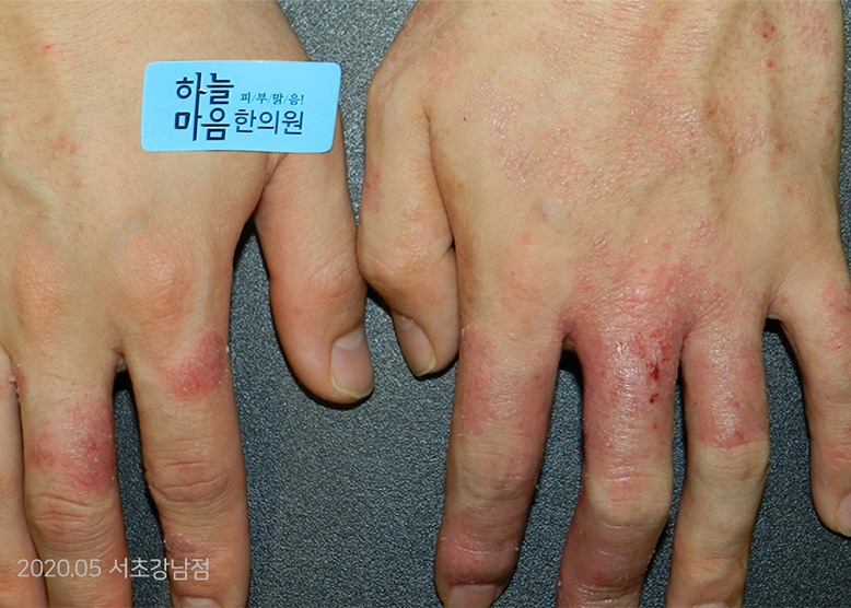 Before Treatment of Dyshidrotic eczema