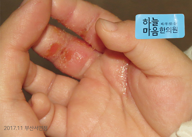 Before Treatment of Dyshidrotic eczema