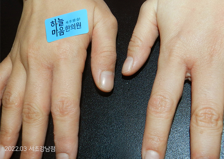 After Treatment of Dyshidrotic eczema