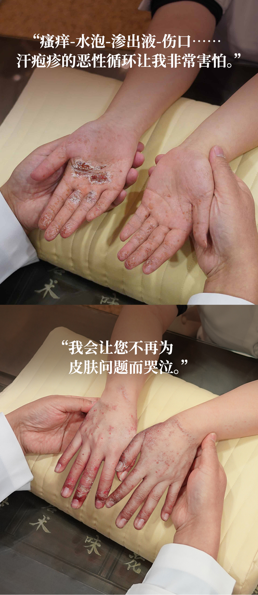 It was terrifying to be trapped in the vicious cycle of itching-blisters-oozing-wounds with dyshidrotic eczema. Stop shedding tears over your skin.