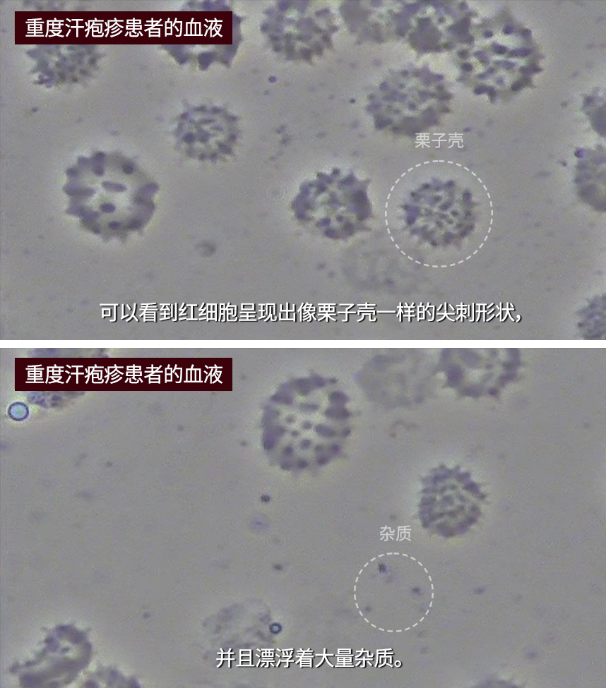 Blood of a patient with severe dyshidrotic eczema 
