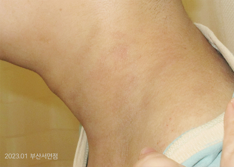 After Treatment of Seborrheic Dermatitis