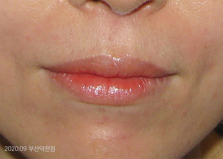 After Treatment of Seborrheic Dermatitis