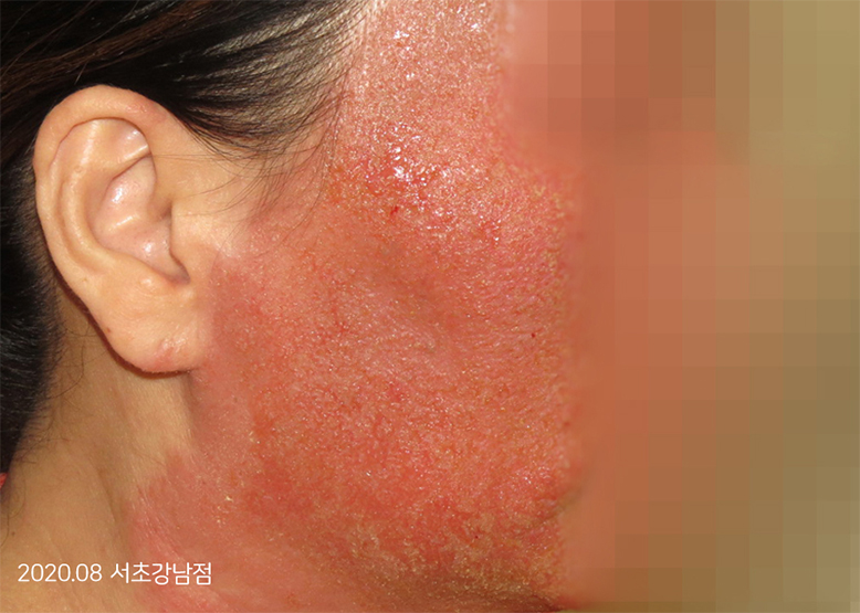 Before Treatment of Seborrheic Dermatitis