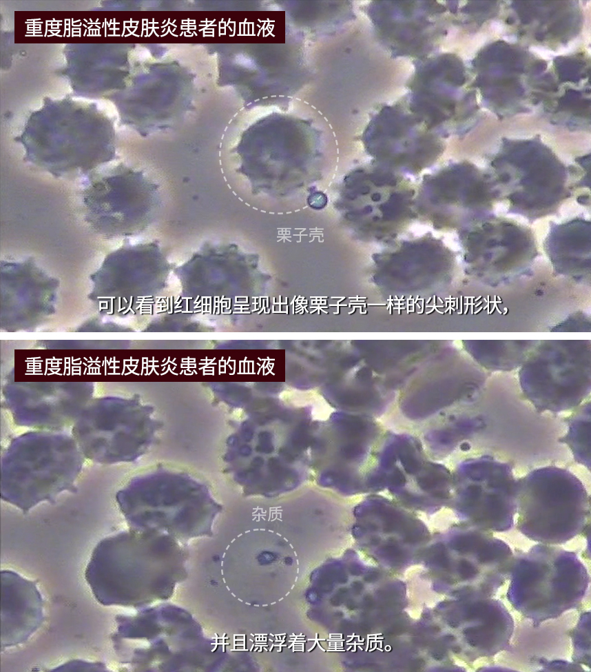 Blood of a patient with severe seborrheic dermatitis