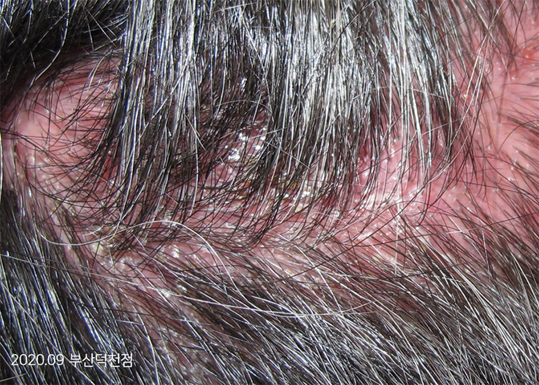 Before Treatment of Seborrheic Dermatitis of the scalp