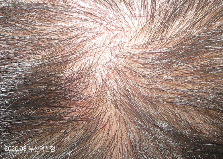 After Treatment of Seborrheic Dermatitis of the scalp