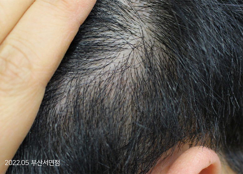 After Treatment of Seborrheic Dermatitis of the scalp