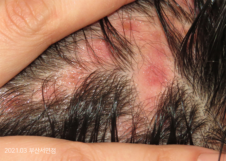 Before Treatment of Seborrheic Dermatitis of the scalp