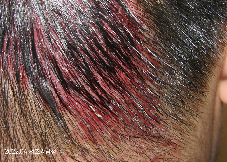 Before Treatment of Seborrheic Dermatitis of the scalp