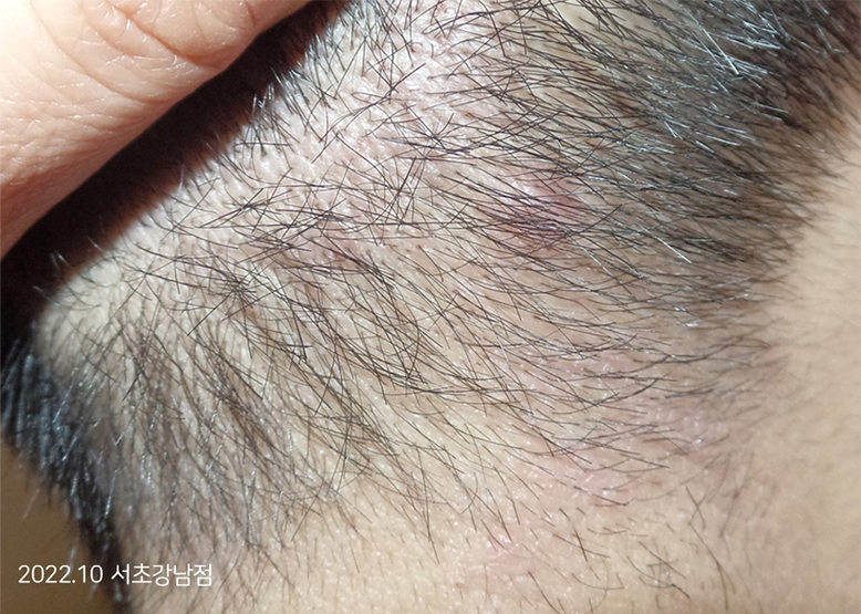 After Treatment of Seborrheic Dermatitis of the scalp