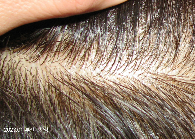 After Treatment of Seborrheic Dermatitis of the scalp