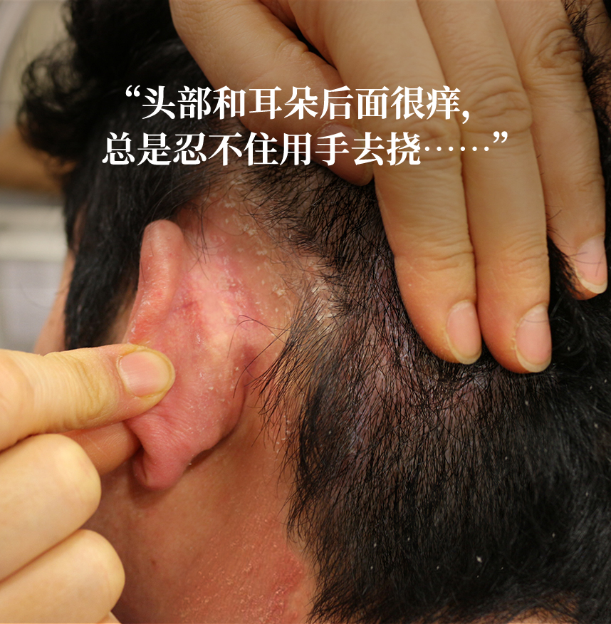 My head and behind my ears are itchy, and I keep scratching...