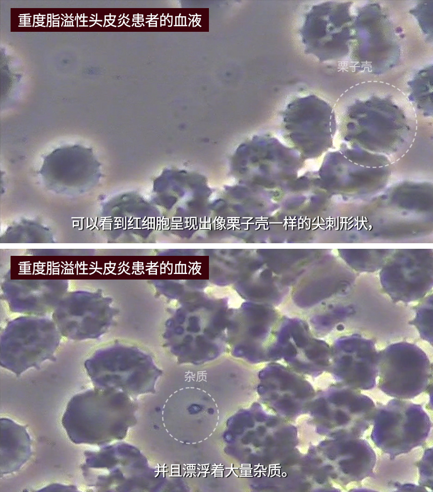 Blood of a patient with severe seborrheic dermatitis of the scalp 